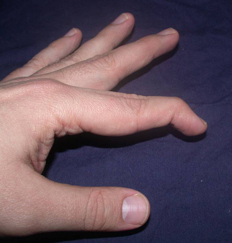 cekic parmak mallet finger yaralanmasi istanbul elcerrahisi